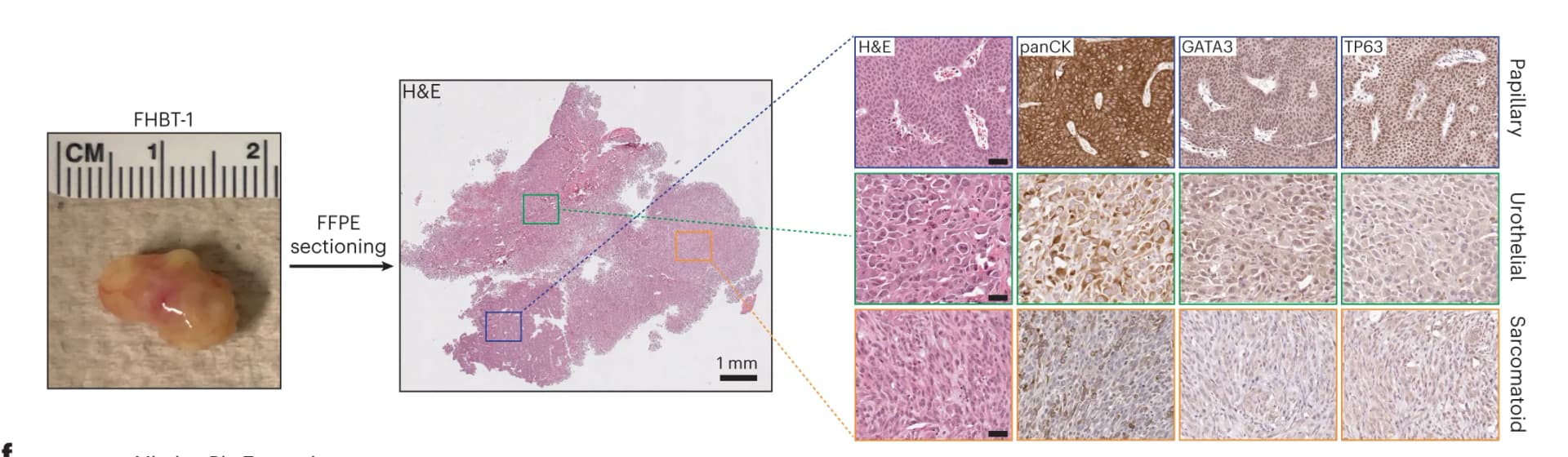 Open access visualization of Microscopy, Photo, Tumor, mBU, BU-LVP