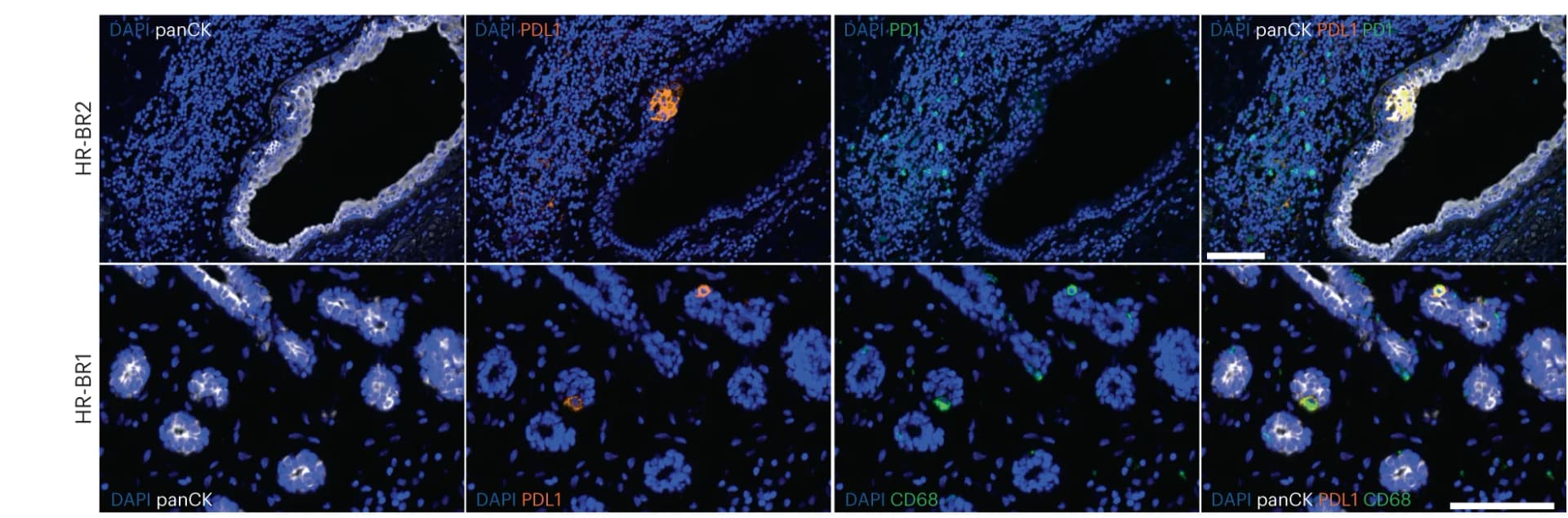 Open access visualization of Microscopy, Ultivue staining, panCK, PDL1, PD1