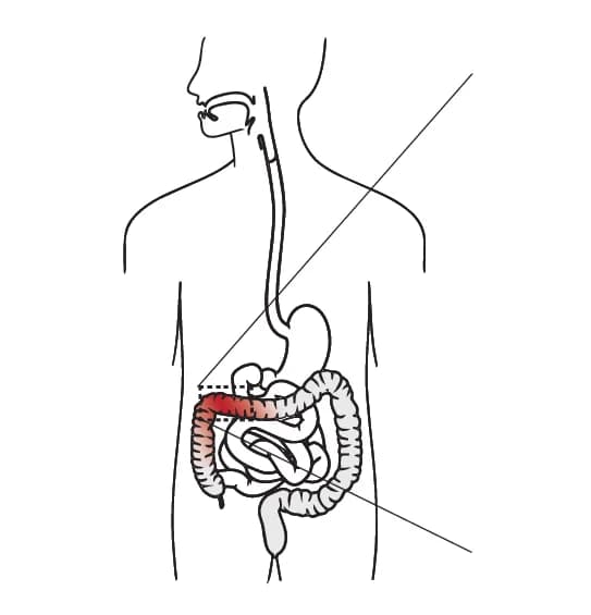 Open access visualization of Illustration, Microsatellite Instability, Colorectal Cancer