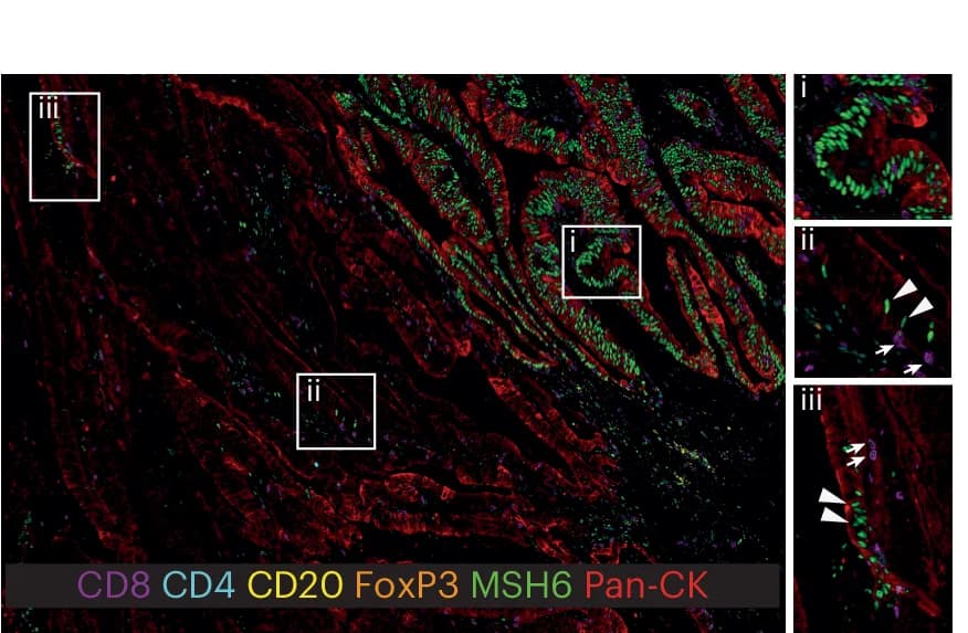 Open access visualization of Microscopy, Multiplex IHC, Tumor Cells, Pan-CK, MSH6 Labeling