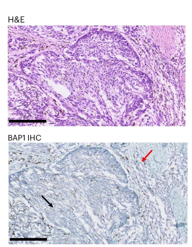 Open access visualization of Microscopy, Pathology, Cutaneous Melanoma, Hematoxylin and Eosin Staining, BAP1 Immunohistochemical Staining