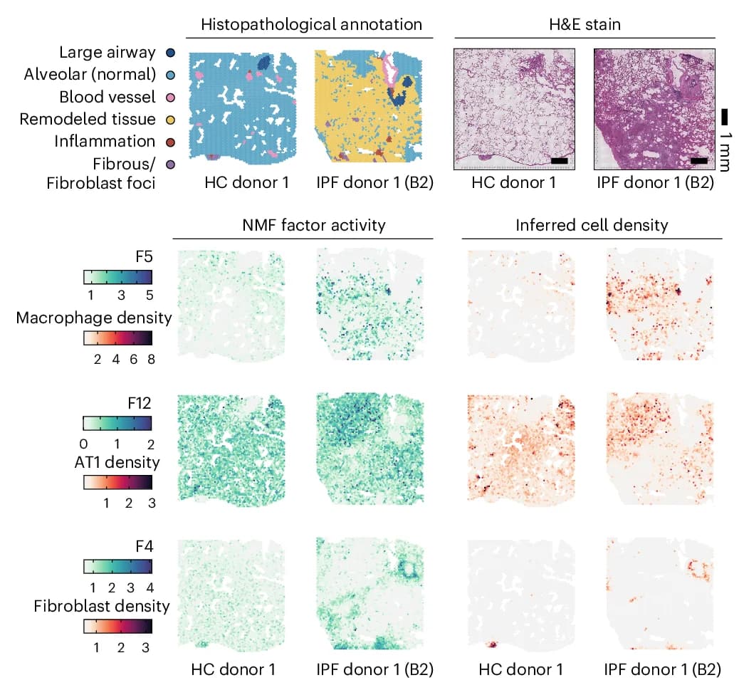 Open access visualization of Microscopy, Histopathological Annotations, Healthy Controls, IPF, H&E-Stained Visium Sections