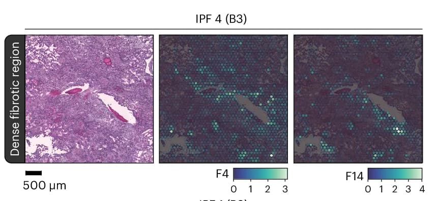 Open access visualization of Microscopy, Heatmap, NMF Factors, IPF Lung Sections, Spatial Localization