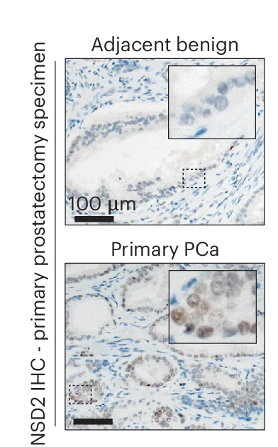 Open access visualization of Microscopy, Immunohistochemistry, IHC, NSD2, Prostatectomy