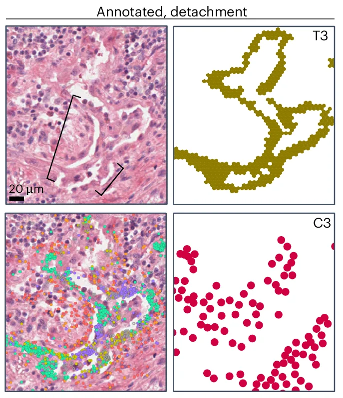 Open access visualization of Microscopy, Scatter Plot, Epithelial Detachment, Clinician Annotation, H&E