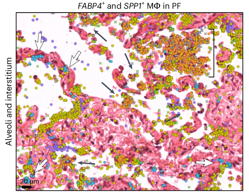Open access visualization of Microscopy, FABP4+ Macrophages, SPP1+ Macrophages, Alveoli, Interstitial Space