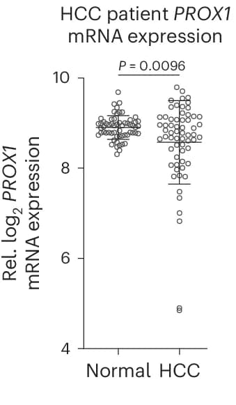 Open access visualization of Scatter Plot, Error Bars, PROX1 Expression, HCC, Tumors