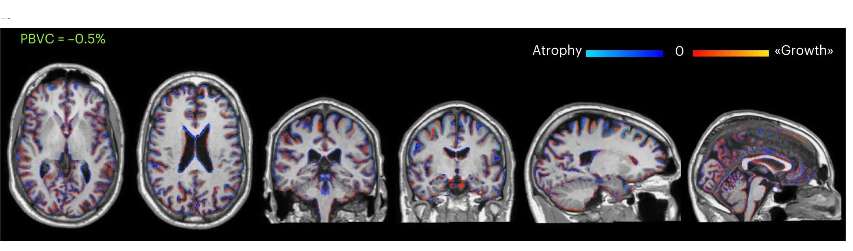Open access visualization of Microscopy, Brain Atrophy, Brain Growth, PBVC, hf NPC Transplantation