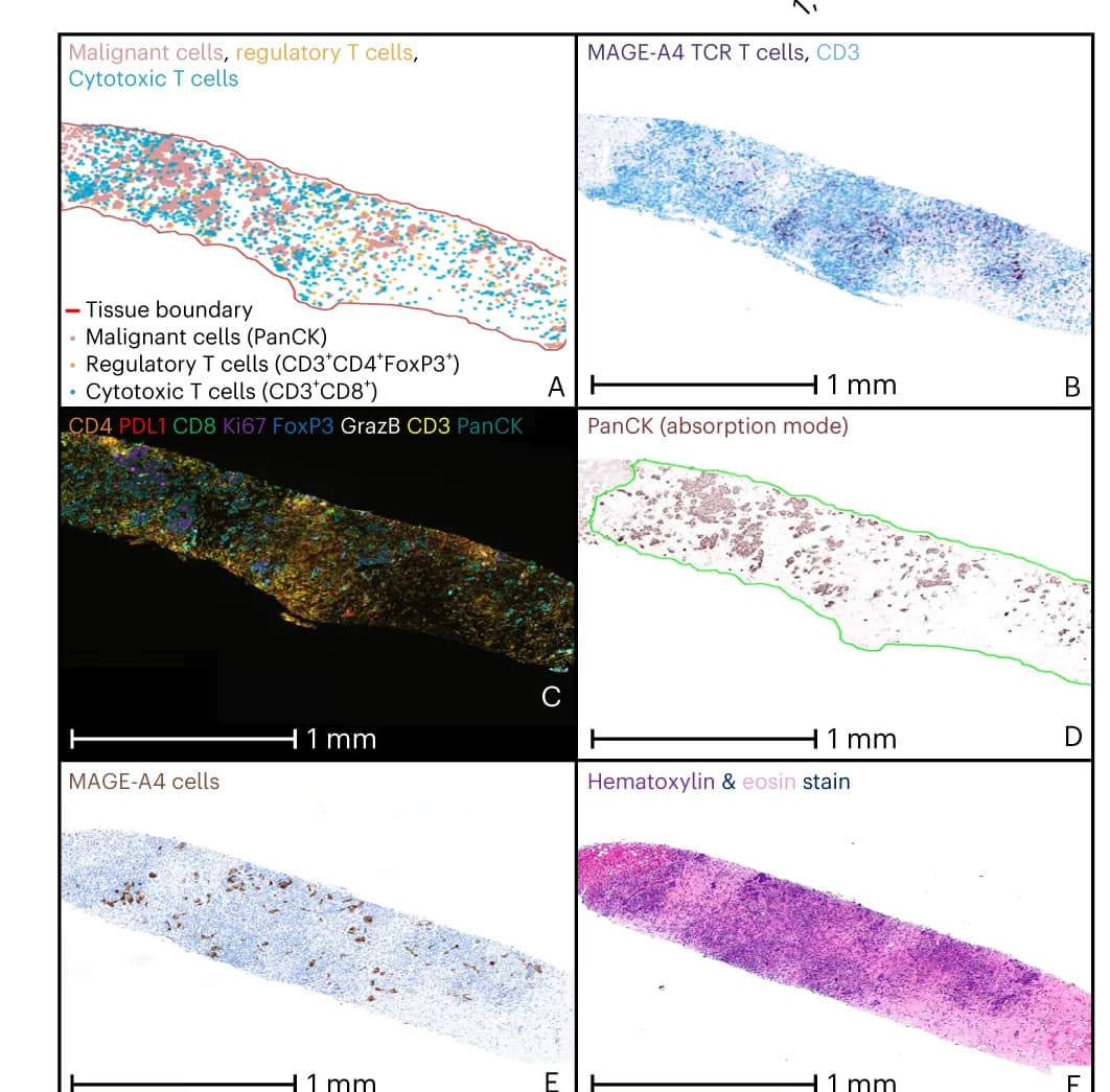 Open access visualization of Microscopy, T Cell Infiltration, Tumor Biopsies, IHC, MAGE-A4 SPEAR RNAscope