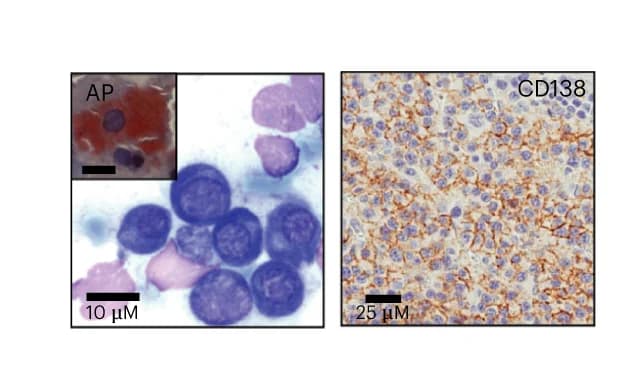 Open access visualization of Microscopy, Giemsa Staining, Bone Marrow, Plasma Cells, Immunohistochemistry