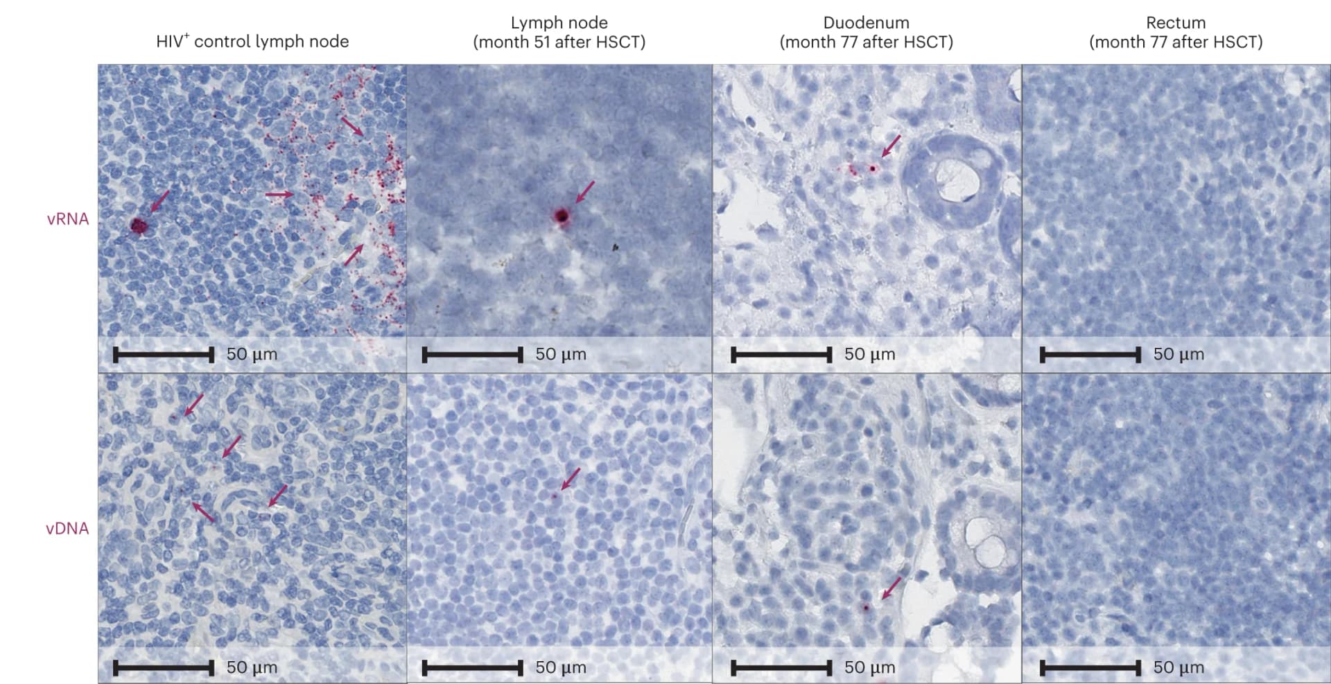 Open access visualization of Microscopy, In Situ Hybridization, Viral DNA, Viral RNA, Lymph Node Tissue