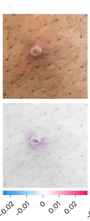 Open access visualization of Photo, Umbilicated Pustule, SHAP Analysis, MPXV Skin Lesion, MPXV-CNN