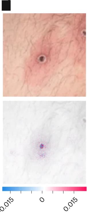 Open access visualization of Photo, Heatmap, Papule with Central Necrosis, SHAP Analysis, MPXV Skin Lesion