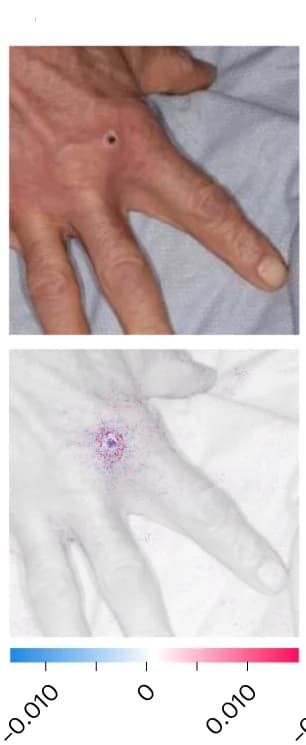 Open access visualization of Photo, Ulcerated Skin Lesion, Hand, SHAP Analysis, MPXV Skin Lesion