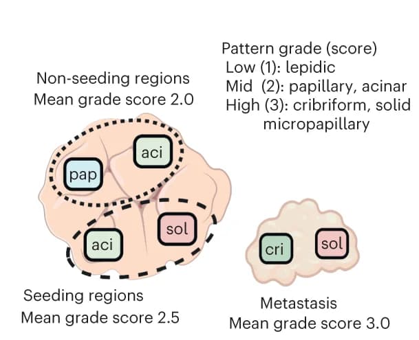 Open access visualization of Illustration, Mean grade scores, Non-seeding regions, Seeding regions, Primary tumor