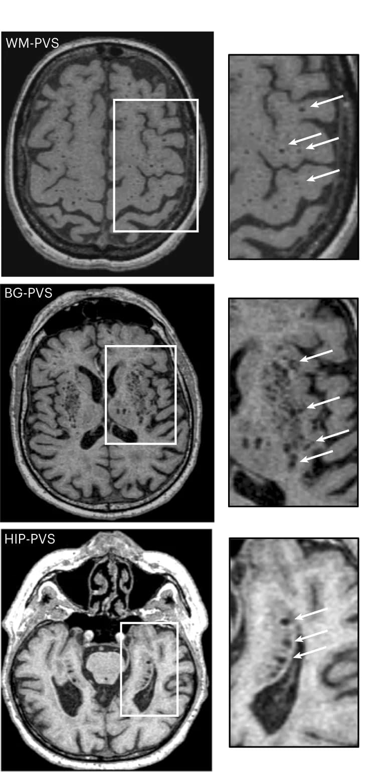 Open access visualization of Microscopy, PVS Burden, White Matter, Basal Ganglia, Hippocampus