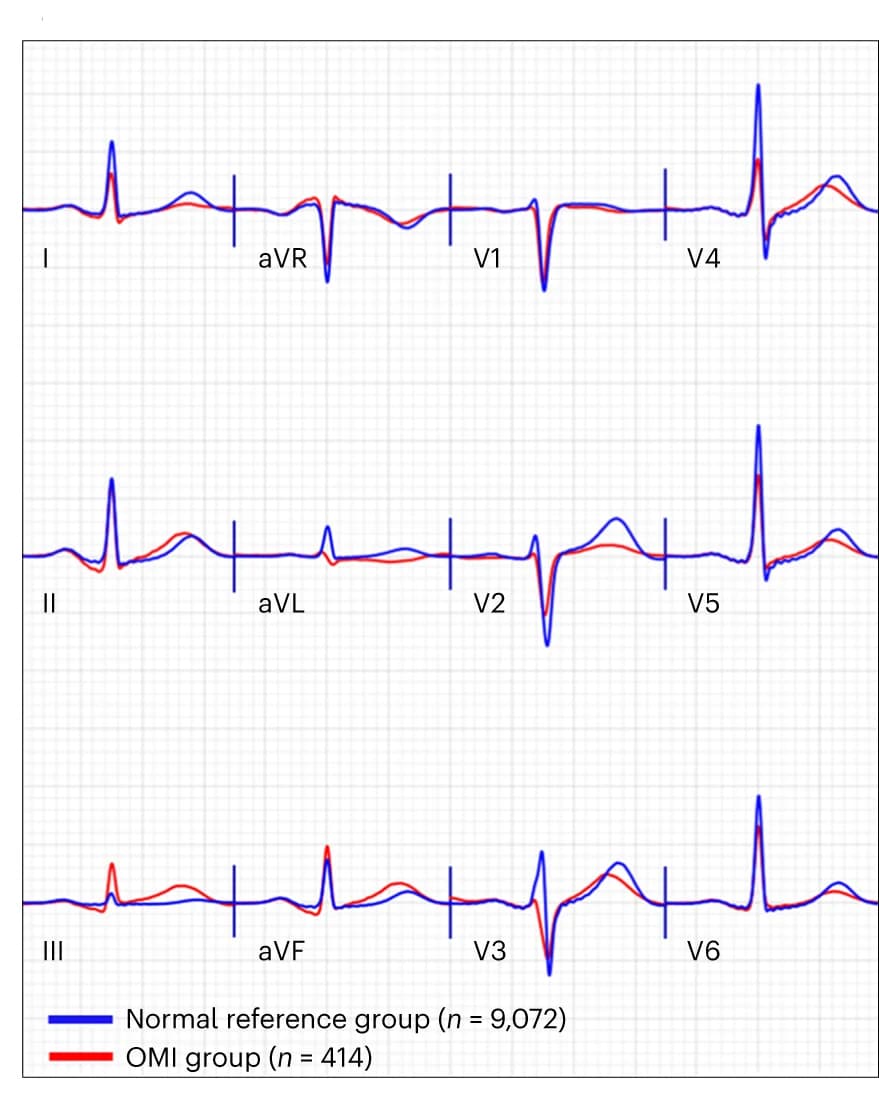 Open access visualization of Line Plot, ECGs, OMI class, Normal sinus rhythm, antConcaveAmp