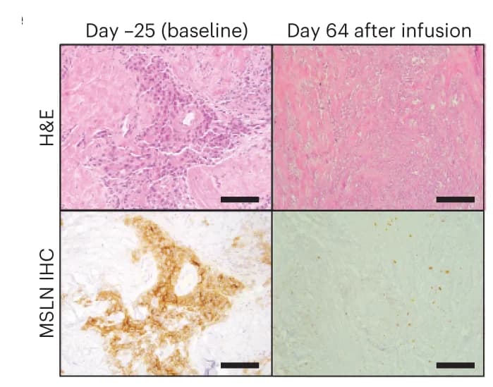 Open access visualization of Microscopy, Mesothelin-specific Cell Killing, Tumor Biopsy, Hematoxylin and Eosin, Mesothelin Expression