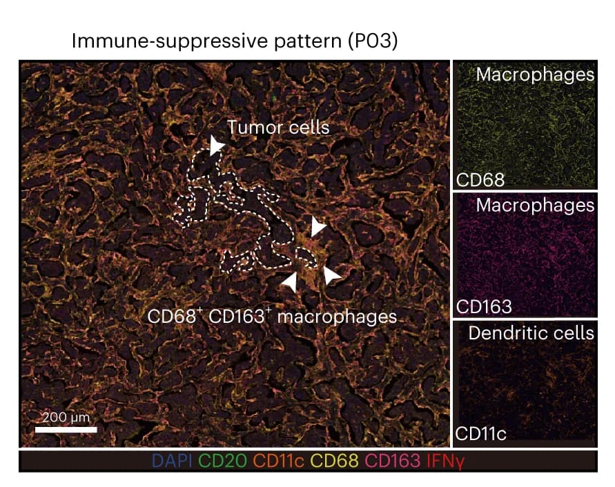 Open access visualization of Microscopy, Multiplex Immunofluorescence, Immune-suppressive Pattern, Poor Responders