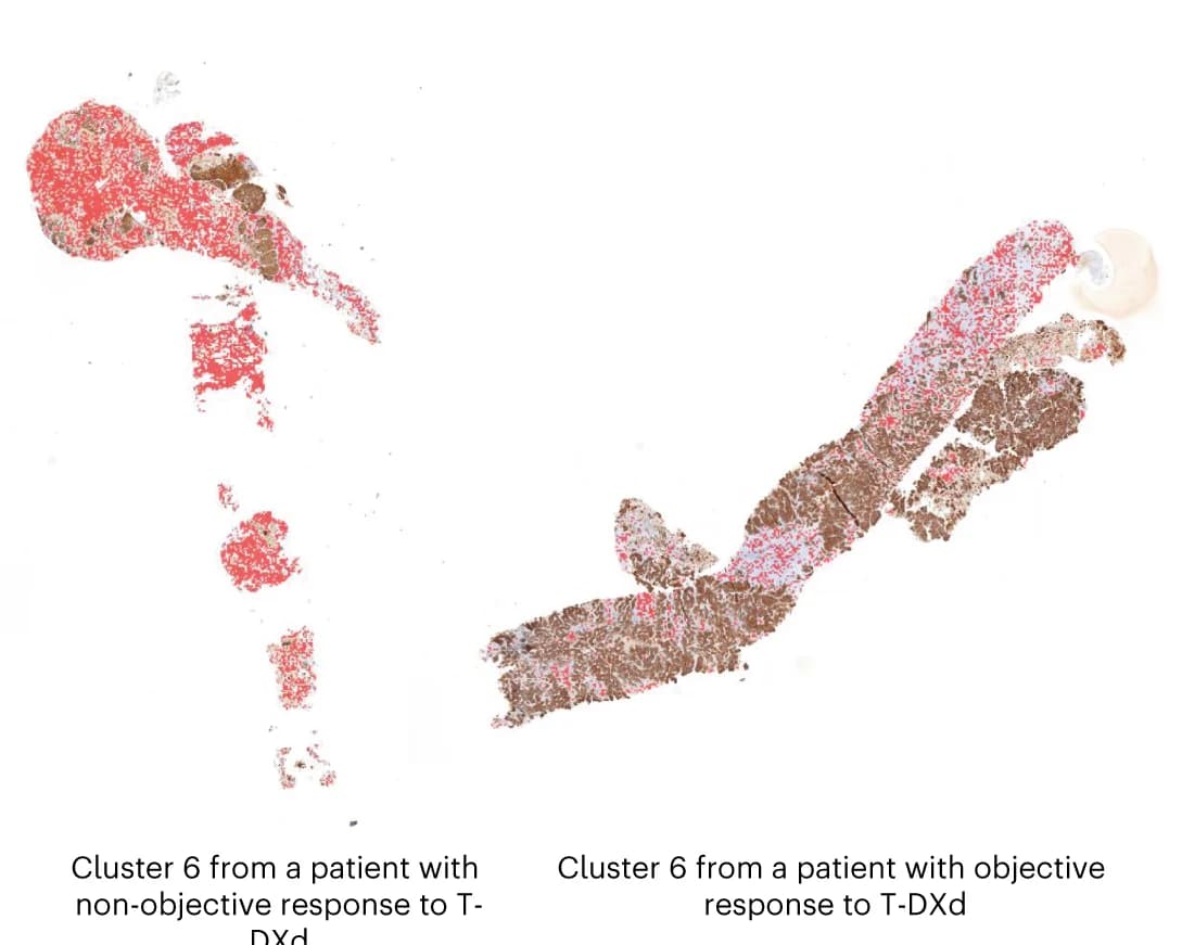 Open access visualization of Microscopy, Pathology Slides, Cluster 6, T-DXd, HER2-negative areas