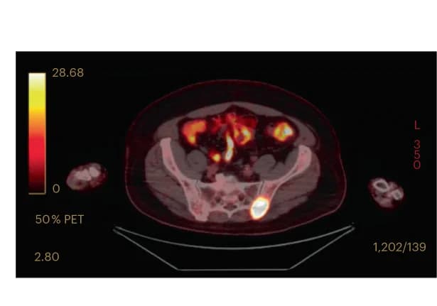 Open access visualization of Microscopy, Positron Emission Tomography, Relapse, BCMA, CAR T cell