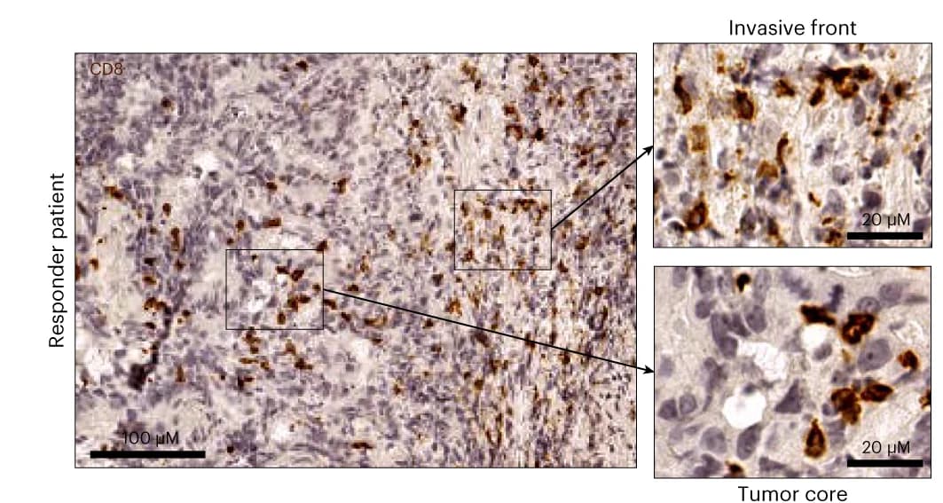Open access visualization of Microscopy, CD8 Staining, CRC Samples, Invasive Front, Tumor Core