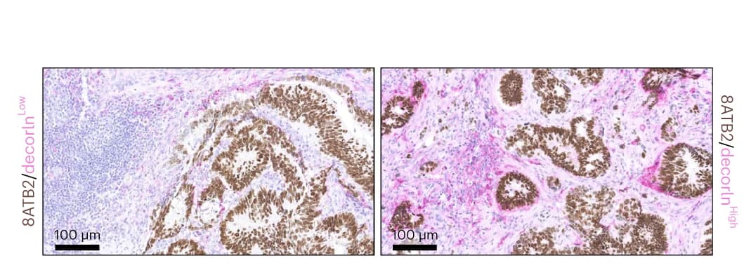 Open access visualization of Microscopy, Decorin Staining, SATB2 Staining, CRC Samples, Protein Expression