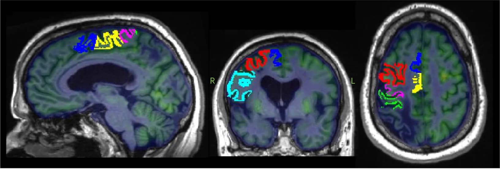Open access visualization of Microscopy, Magnetic Resonance Imaging, Positron Emission Tomography, Stroke Lesion, Motor Cortex