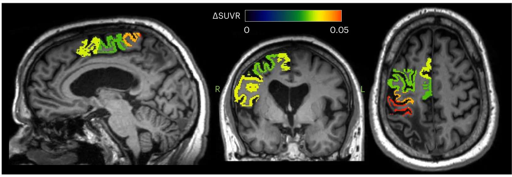 Open access visualization of Microscopy, Standardized Uptake Value Ratio, Deep Brain Stimulation, Rehabilitation, Motor Cortex