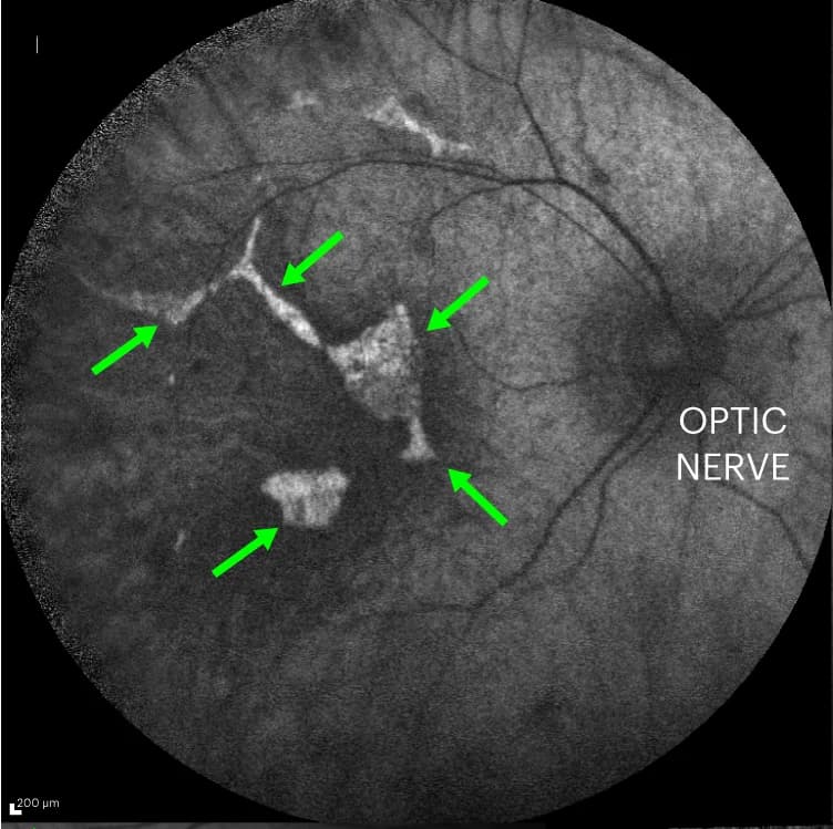 Open access visualization of Microscopy, Retinal Pigment Epithelium, AF Imaging