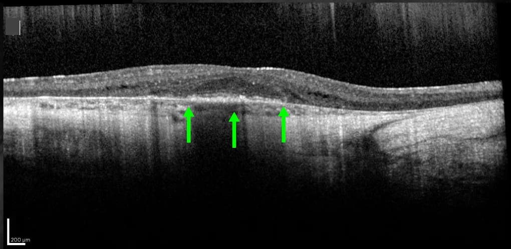 Open access visualization of Microscopy, Outer Nuclear Layer, Outer Segments, Degeneration