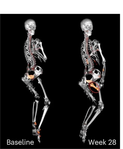 Open access visualization of Protein Structure, Baseline, PET-CT Fusion Images, Placebo, Femoral Bridge