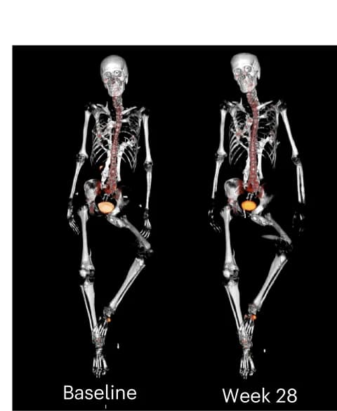 Open access visualization of 3D Plot, Garetosmab, HO, PET-CT, Baseline