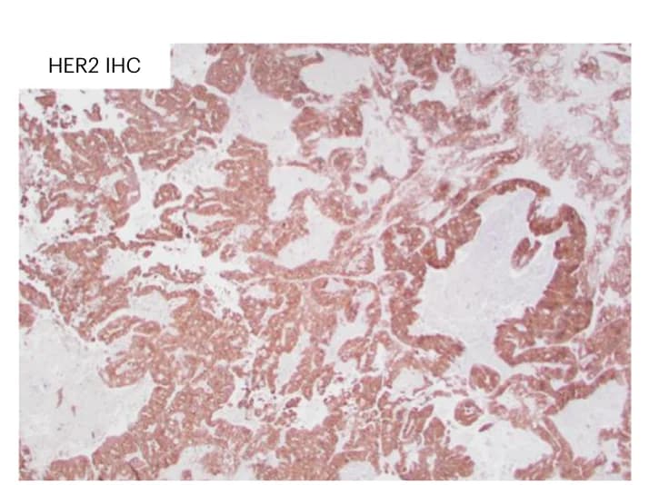 Open access visualization of Microscopy, IHC Staining, HER2, Brain Metastasis, CRC