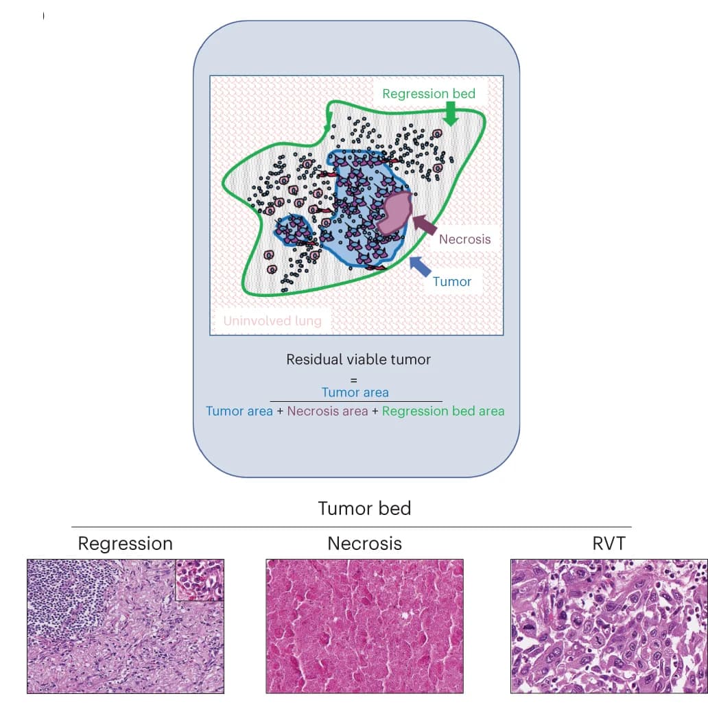 Open access visualization of Illustration, Microscopy, irPRC Scoring, Photomicrographs, Histologic Components