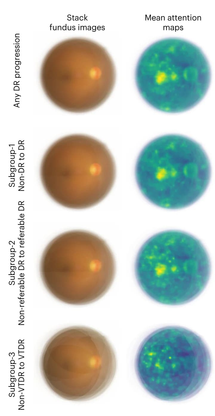 Open access visualization of Microscopy, Heatmap, Attention Maps, Fundus Images, DR Progression