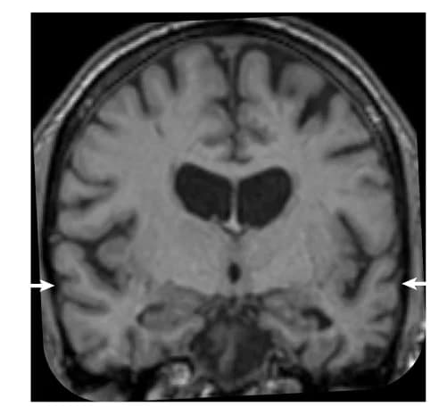 Open access visualization of Photo, T1-weighted MRI, Temporal Lobes, Volume Loss, Atrophy