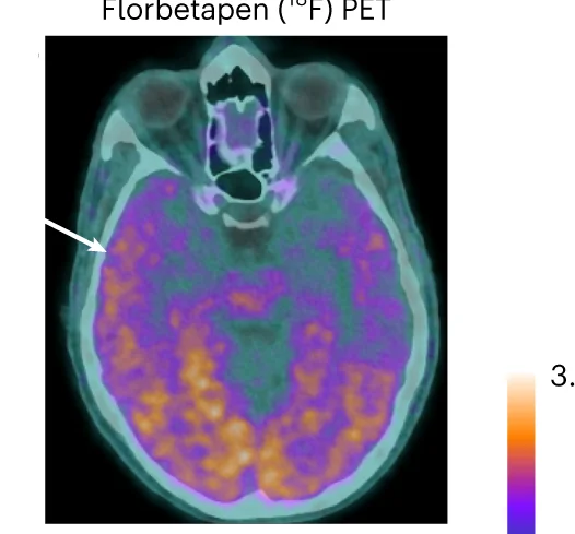 Open access visualization of Microscopy, Axial PET, Tracer Uptake, Cortex, White Matter