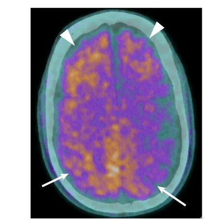 Open access visualization of Photo, Axial PET, Tracer Uptake, Parietal Lobules, Frontal Lobes