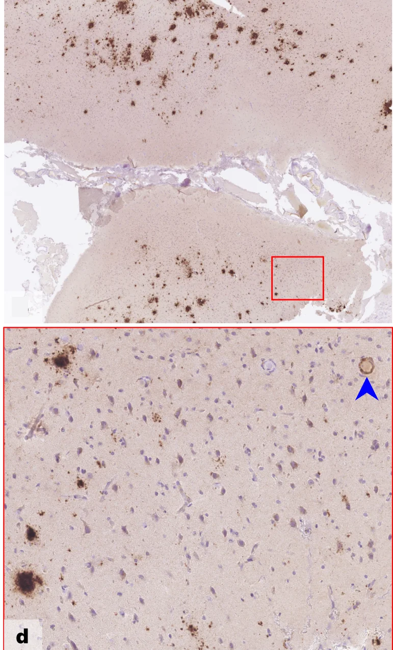 Open access visualization of Microscopy, Immunostaining, A Amyloid, Parenchymal Deposits, Brain Biopsy