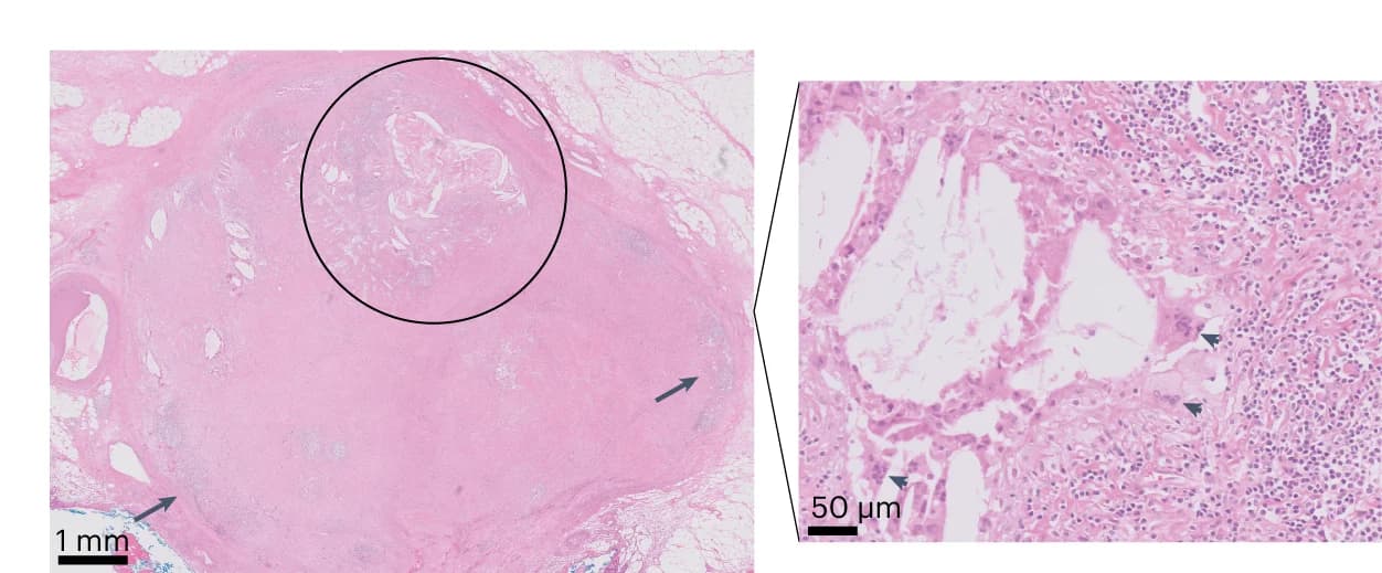 Open access visualization of Microscopy, H&E Stains, Lymph Node, Lymphoid Tissue, Tumor Regression