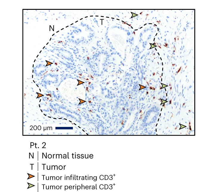Open access visualization of Microscopy, CD3 Immunohistochemistry, Hepatic Tumor Biopsy, Contrast Avid Lesion, Computed Tomography
