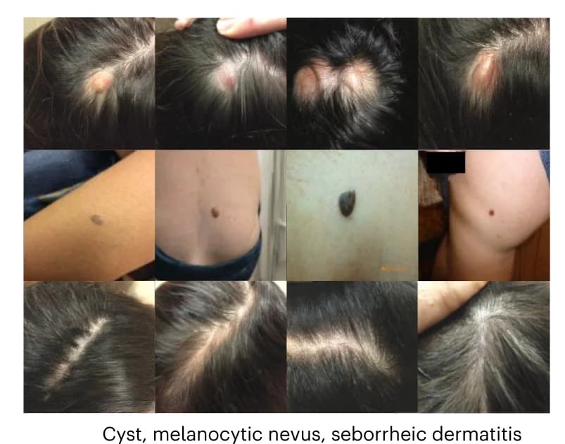 Open access visualization of Photo, Cyst, Melanocytic Nevus, Seborrheic Dermatitis