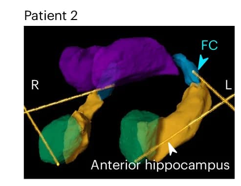 Open access visualization of 3D Plot, sEEG Electrodes, Amygdala, Anterior Hippocampus, FC