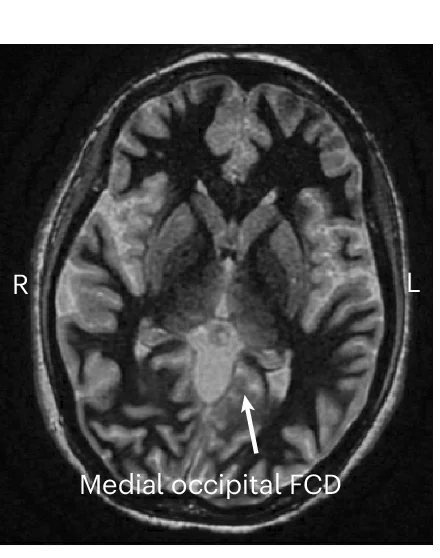 Open access visualization of Photo, MRI, Focal Cortical Dysplasia, Gray Matter