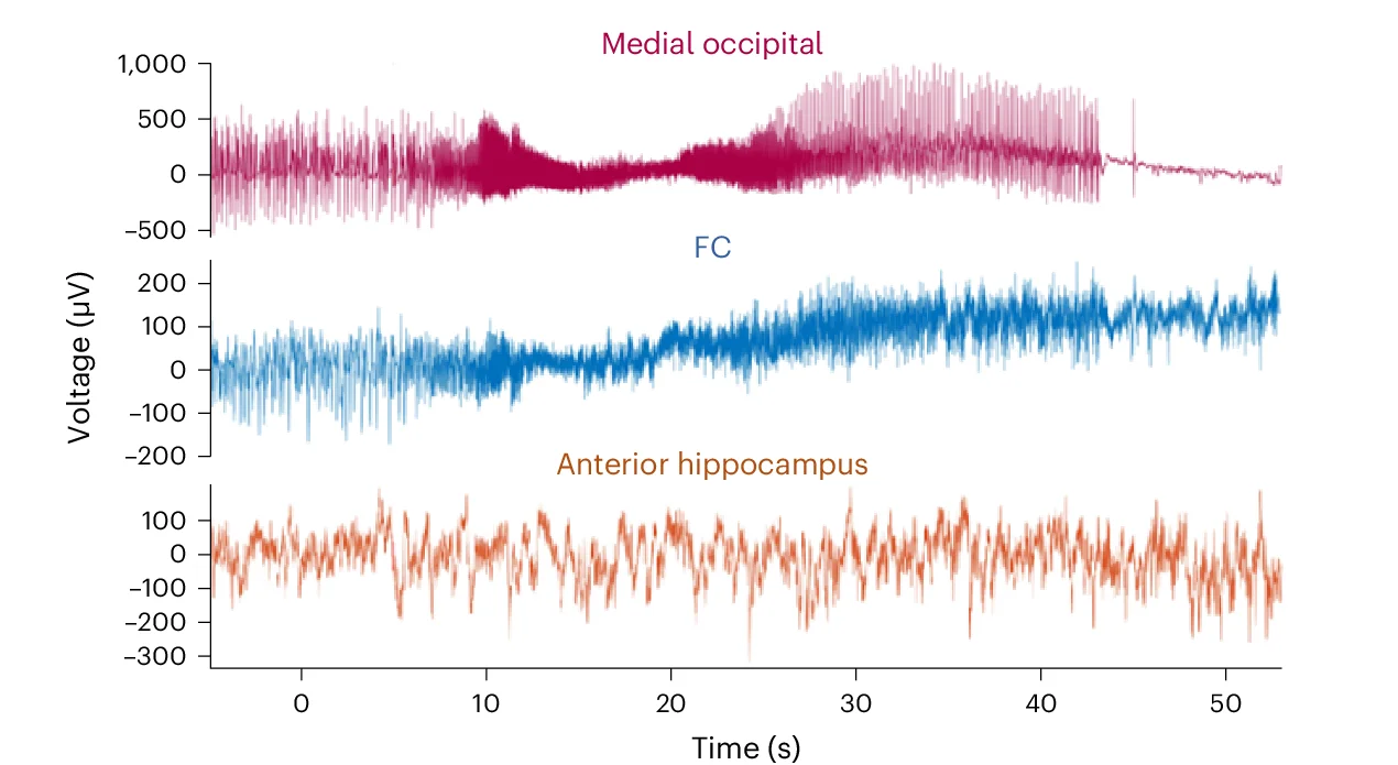 Open access visualization of Line Plot, LFP Trace, Seizure, Focal Cortical Dysplasia, Medial Occipital Cortex
