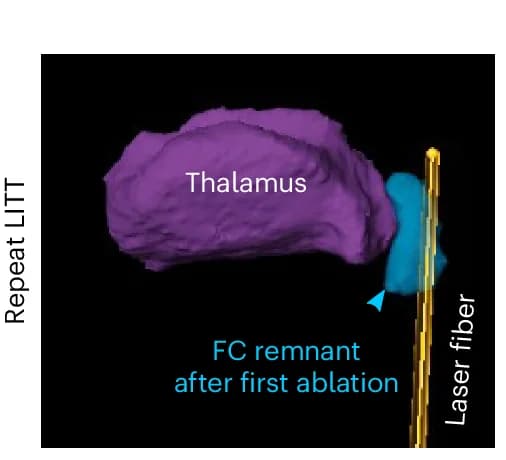 Open access visualization of 3D Plot, Three-Dimensional Reconstruction, Post-Contrast T1 MRI, Laser Fiber, Hippocampal Tail