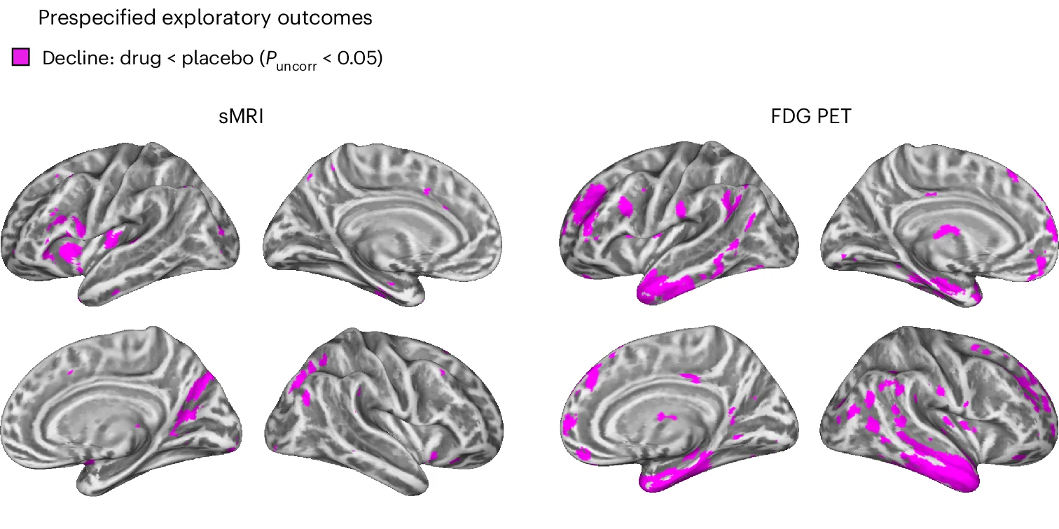Open access visualization of 3D Plot, Protein Structure, Longitudinal Degeneration, Glucose Hypometabolism, sMRI