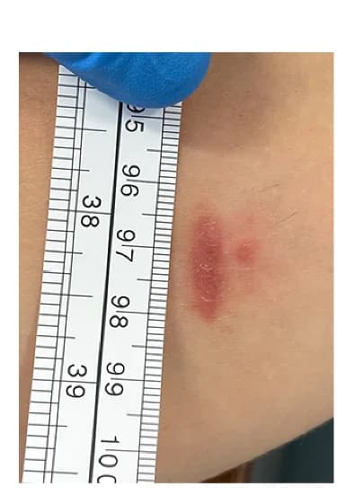 Open access visualization of Photo, Lesion, Punch Biopsy, Cryotherapy, Images