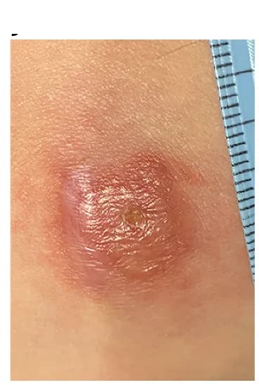 Open access visualization of Photo, Lesion, Punch Biopsy, Cryotherapy, Images